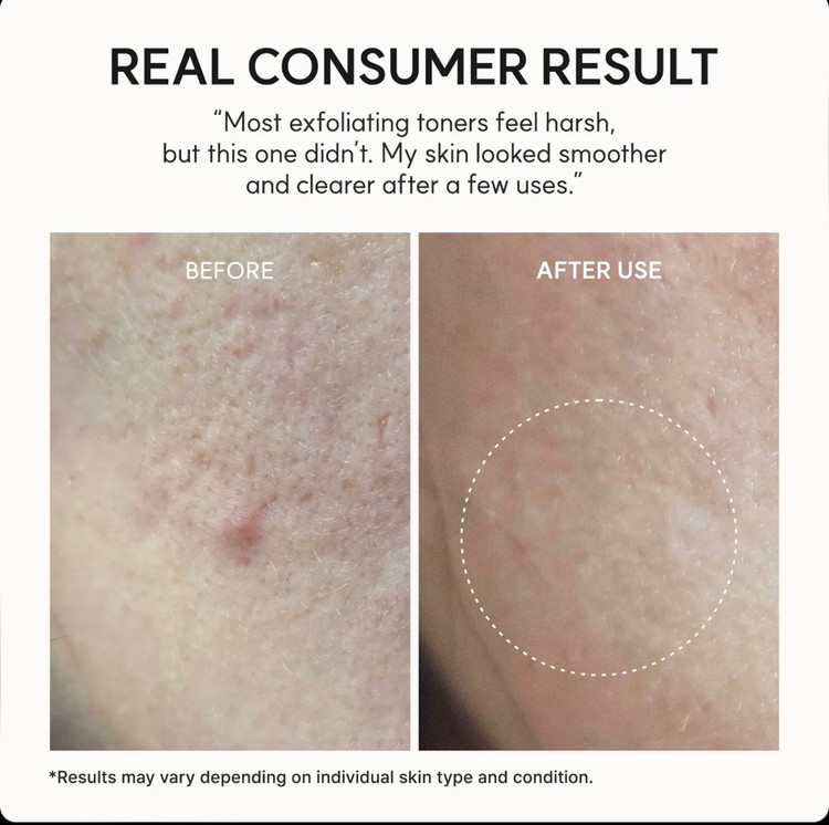 تونر لایهبردار و پاکسازیکننده آرنسیا Arencia Eraser Shot Glycolic Acid Exfoliator حاوی 10٪ گلیکولیک اسید، سالیسیلیک اسید و هیالورونیک اسید حجم 200 میل